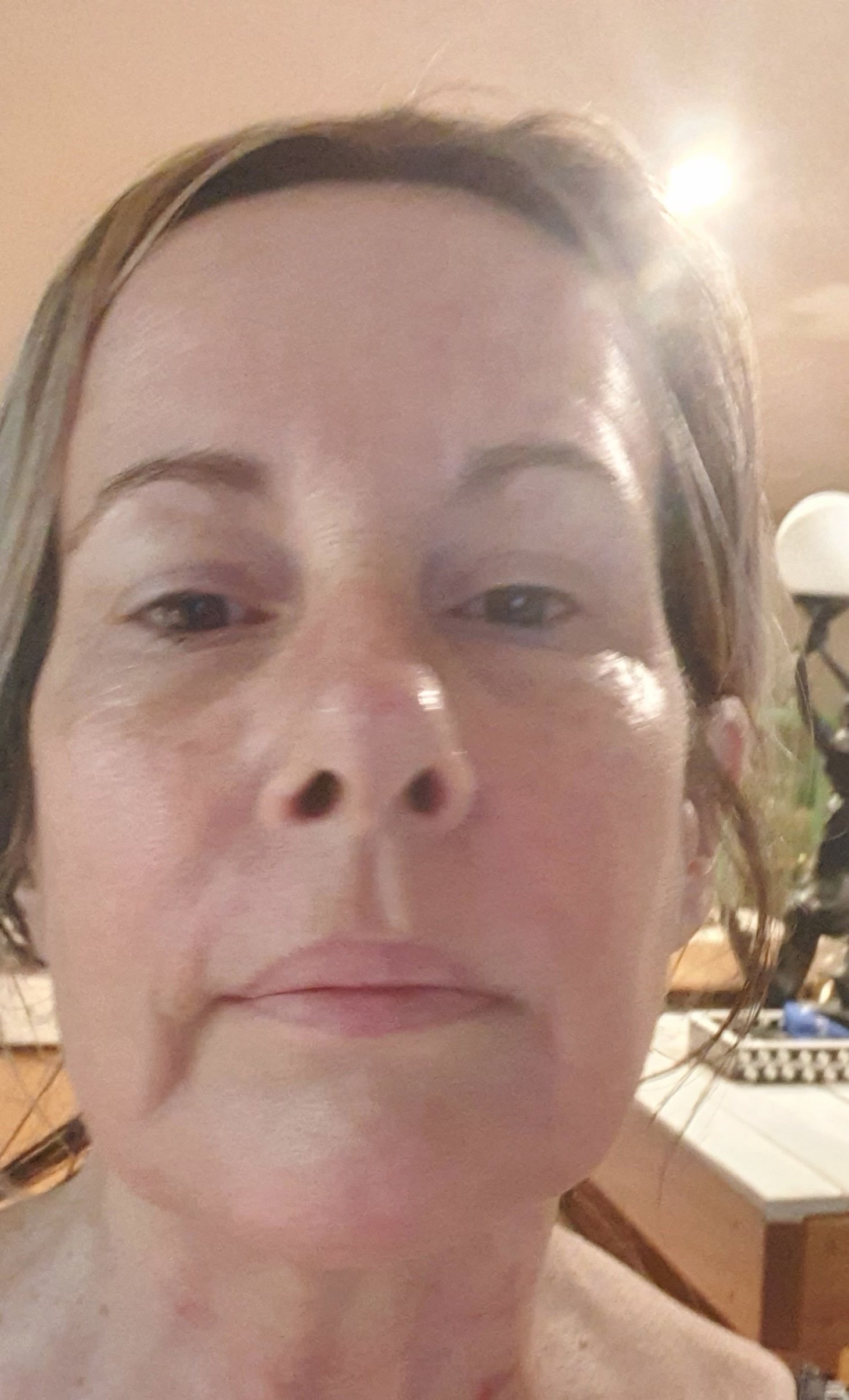 Facial Resurfacing Before